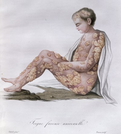 Ringworm, paroni Jean Louis Alibertin (1768-1837) kirjasta 1838 tekijältä French School