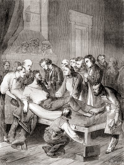 Amerikkalaisen hammaslääkärin William Thomas Green Mortonin ensimmäinen julkinen esitys inhaloitavan eetterin käytöstä kirurgisena anestesiana vuonna 1846 Les Merveilles de la Science -julkaisusta, julkaistu noin 1870 tekijältä French School