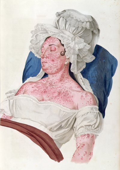 Nainen, jolla on tulirokko, paroni Jean Louis Alibertin (1768-1837) kirjasta, Choupardin kaiverrus, 1833 tekijältä French School