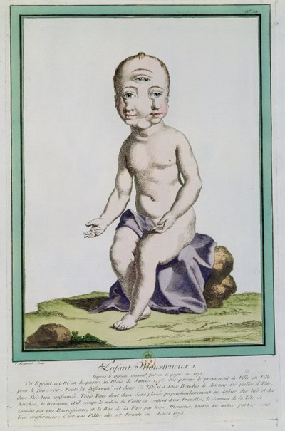 Lapsi, jolla on epämuodostunut pää, "Les Ecarts de la Nature", Pariisi, 1775 tekijältä Genevieve Regnault de Nangis
