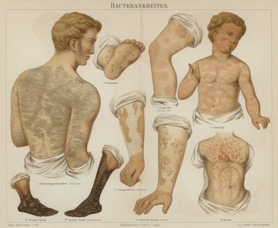 Ihosairaudet (väri litho) tekijältä German School