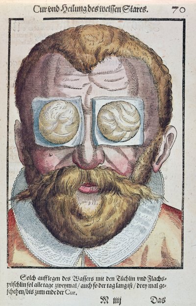 Silmäsairauden hoito, Georg Bartischin (1535-1636) Ophthalmodouleiasta, joka julkaistiin Dresdenissä vuonna 1583 (värillinen puupainatus) tekijältä German School