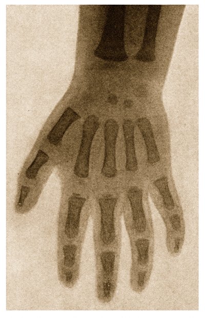 Lapsen käden röntgenkuva n. 1890 tekijältä German School