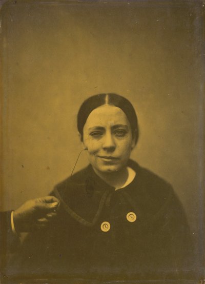 Leichte Senkung des Mundwinkels durch Depression (links); Falsches Lachen (rechts), 1854-1856, gedruckt 1862 von Guillaume-Benjamin-Armand Duchenne de Boulogne