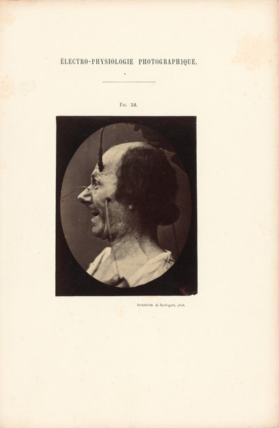 Valokuvasähköfysiologia, kuva 39. tekijältä Guillaume Benjamin Duchenne
