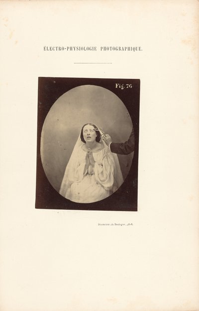 Valokuvasähköfysiologia, kuva 76 tekijältä Guillaume Benjamin Duchenne
