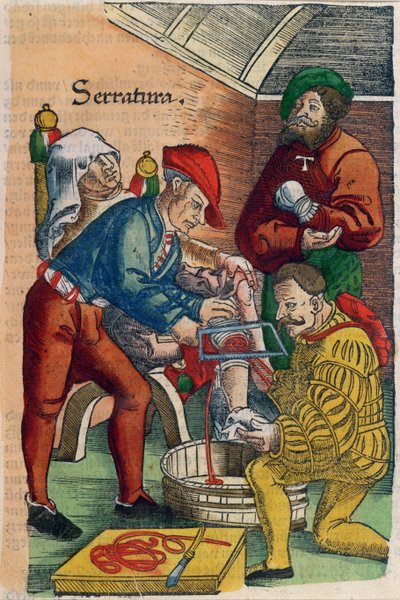 Amputaatio, kuvitus Hans von Gersdorffin teoksesta "Feldtbuch der Wundartzney", n. 1540 (värillinen puupainatus) tekijältä Hans or Johannes Ulrich Wechtlin