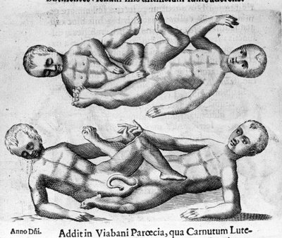 Erityyppiset ihmishirviöt: Siamilaiset lapset, joita yhdistää lantio. Italian tiedemiehen Fortunio Licetin (1577-1656) kaiverrus "Hirviöiden luonne, syyt ja erot". 1646 tekijältä Italian School