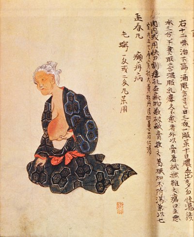 Ensimmäinen rintasyövän kirurginen hoito, jonka suoritti Seishu Hanaoka (1760-1836) yleisanestesiassa vuonna 1804 tekijältä Japanese School