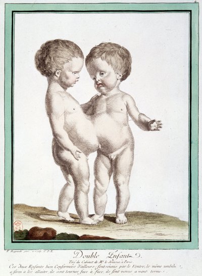 Siamilaiset lapset - Régnaultin "" Luonnon poikkeamat" -osassa tekijältä Jean Baptiste Regnault
