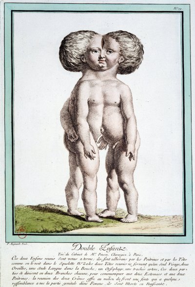 Siamilaiset lapset - Régnaultin "" Luonnon poikkeamat" -osassa tekijältä Jean Baptiste Regnault