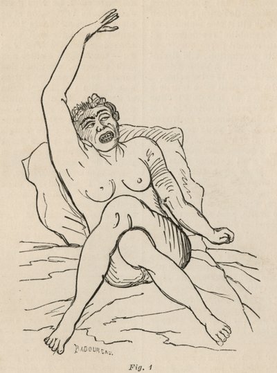 Hysteerinen epilepsia, kohtaus, vääntymät, kuva. 1 teoksesta "Iconographie Photographique de La Salpetriere", Bourneville et P. Regnard, Pariisi, 1876 tekijältä Jean Francois Badoureau