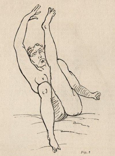 Hysteerinen epilepsia, kohtaus, kouristukset, kuva 2 Bourneville et P.:n "Iconographie Photographique de La Salpetriere" -teoksesta. Regnard, Pariisi, 1876 tekijältä Jean Francois Badoureau