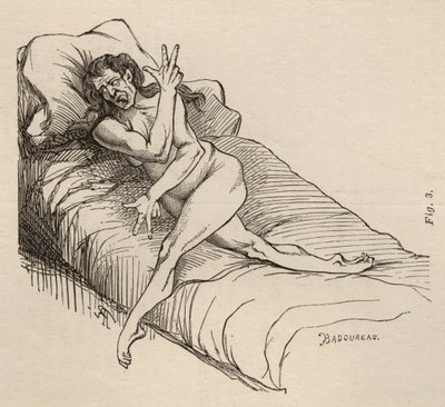 Hysteerinen epilepsia, kohtaus, vääntymät, kuva. 3 teoksesta "Iconographie Photographique de La Salpetriere", Bourneville et P. Regnard, Pariisi, 1876 tekijältä Jean Francois Badoureau