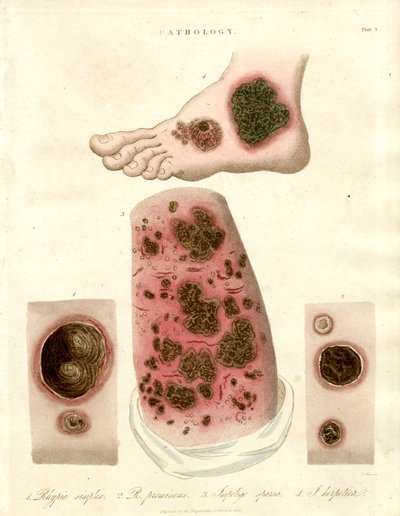 Patologiset ihosairaudet - Pityria, märkärupi ja kuppa ja syfilis tekijältä John Pass