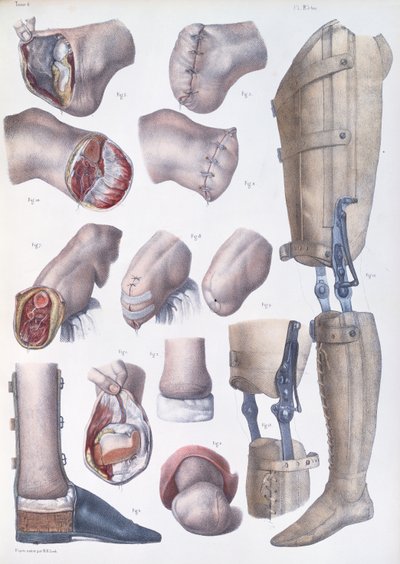 Amputaatiot ja proteesit, levy Jean-Baptiste Marc Bourgeryn (1797-1849) "Traite Complet de l