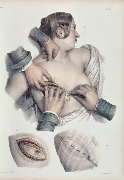 Syöpäkasvaimen leikkaus, Jean-Baptiste Marc Bourgery (1797-1849) 1866-67 Traite Complet de l