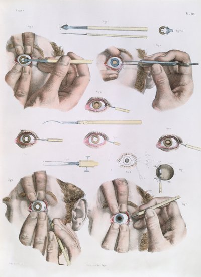 Silmäleikkaus, lautanen Jean-Baptiste Marc Bourgeryn (1797-1849) "Traite Complet de l