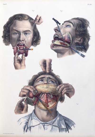 Leikkaus alaleuassa, levy Jean-Baptiste Marc Bourgeryn (1797-1849) "Traite Complet de l