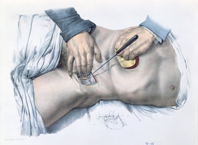 Valtimon sitominen, Jean-Baptiste Marc Bourgeryn (1797-1849) 1866-67 Traite Complet de l