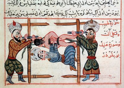Murtuman vähentäminen. Miniatyyri Sharaf al-dinin turkkilaisen lääketieteen kohteesta tekijältä Ottoman School