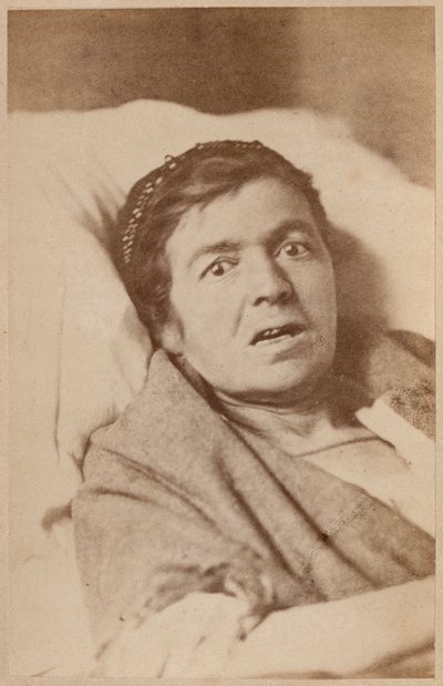 Hysteerinen epilepsia, kasvojen supistuminen, levy VIII Bournevillen ja P. Regnardin teoksesta "Iconographie Photographique de La Salpetriere", Pariisi, 1876 (albumiprintti) tekijältä Paul Regnard