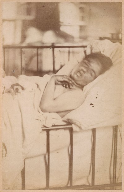 Hysteerinen epilepsia, pysyvä supistuminen, levy XXVIII Bournevillen ja P. Regnardin teoksesta "Iconographie Photographique de La Salpetriere", Pariisi, 1876 (albumiprintti) tekijältä Paul Regnard