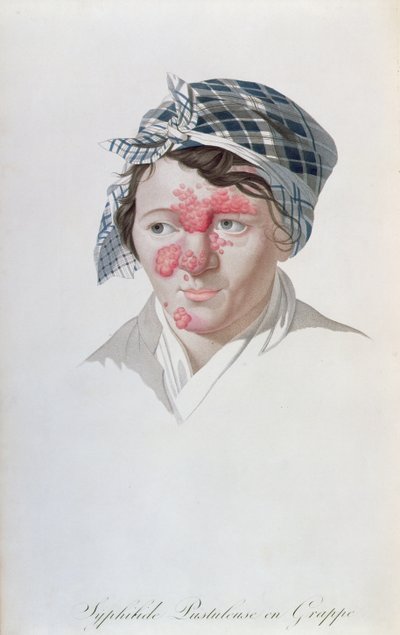 Syfiliset klusterin märkärakkulat, paroni Jean Louis Alibertin (1768-1837) kirjasta 1838 tekijältä Salvadore Tresca