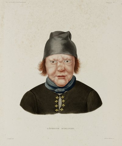 Sairaudet, Lepra Naaraspitaalinen, Islanti, 1800-luvun alku tekijältä Unbekannt