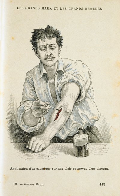 Haavan maalaus antiseptisellä liuoksella, c1890 tekijältä Unbekannt