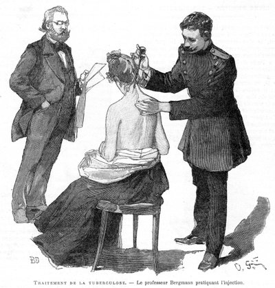 Professori Bergmann ruiskeena tuberkuloosipotilaalle, 1891 tekijältä Unbekannt