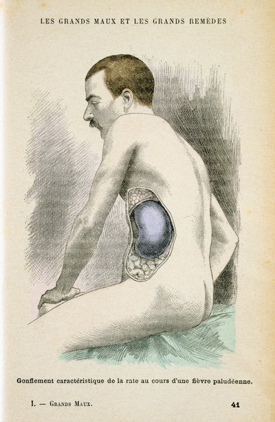 Tyypillinen suurentunut perna malariapotilaalle, c1890 tekijältä Unbekannt