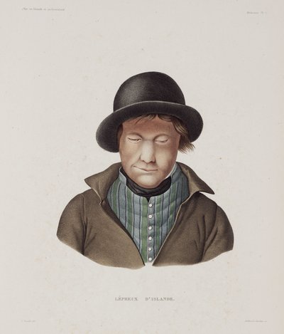 Sairaudet, Lepra Mies spitaalinen, Islanti, 1800-luvun alku tekijältä Unbekannt