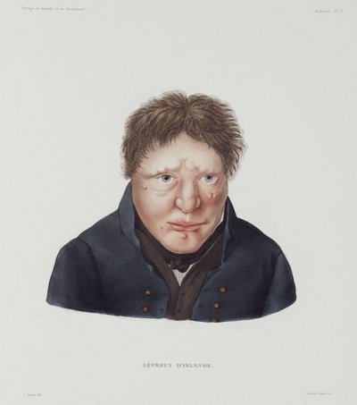 Sairaudet, Lepra Mies spitaalinen, Islanti, 1800-luvun alku tekijältä Unbekannt