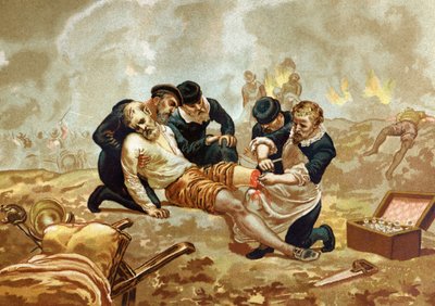 Ambroise Pare Medicine ja ranskalainen kirurgi (n. 1509-1590) harjoittavat valtimoiden ligaatiota amputaation jälkeen. of after hombres y Mujeres julkkikset. Barcelona 1877. tekijältä Unknown artist