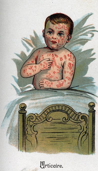 Lasten sairaudet: Nokkosihottuma. F.E. Bilzin teoksessa ”Uusi luonnonlääketiede”. tekijältä Unknown artist