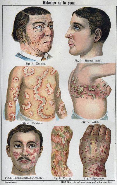 Ihosairaudet: Ekseema, huuliherpes, psoriaasi, vyöruusu, lapus (mädäntyvä tikka), kutina, punoitus. Uusi luonnollinen lääke”, F.E. Bilz. tekijältä Unknown artist