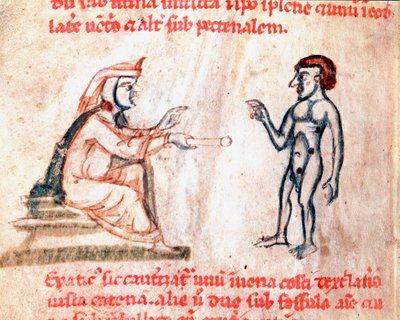 Lääkäri polttaa potilaan kipeille alueille kuumilla raudoilla Miniatyyri käsikirjoituksesta "De Medicina cauteriorum secundum Bruno, Rugerium et Rolthe" 1200-luvulta Paris, B.N. tekijältä Unknown artist