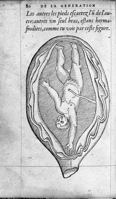 Sikiön sijainti kohdussa raskauden aikana. Kaiverrus ranskalaisen lääkärin ja kirurgin Ambroise Paren (1509-1590) teoksesta "De la Generation des enfants" 1500-luku tekijältä Unknown artist