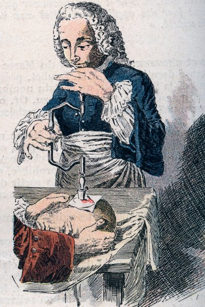 Trepanaatio. 1700-luvun printti. tekijältä Unknown artist