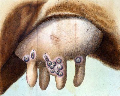 Luigi Saccon (1769-1836) isorokkorokote rokotettiin lehmän rintaa tammikuussa 1801. Lääketieteellinen levy "" Vaccination Treat -tuotteesta, Luigi Sacco, Milano tekijältä Unknown artist