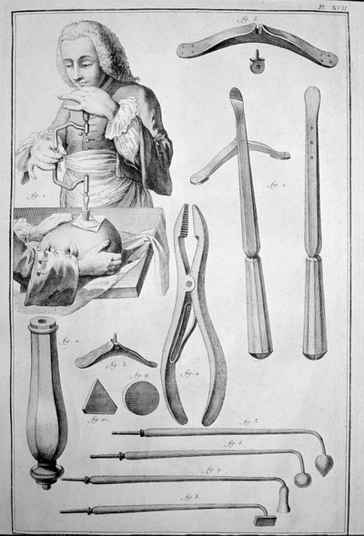 Kallon trepanaatio, erilaiset instrumentit (kaiverrus tekijältä Unknown artist