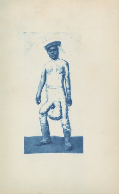 Elefantiasis,c. 1870-luku (kuva) tekijältä Unknown photographer