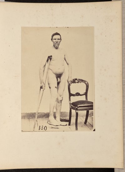 Oikean reisiluun keskimmäisen kolmanneksen yhdistetty ampumamurtuma. tekijältä William H. Bell