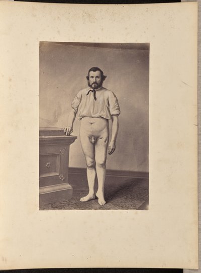 Onnistunut vasemman reisiluun pään poisto ampumamurtuman vuoksi. tekijältä William H. Bell