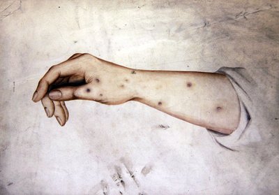 Tutkimus kyynärvarresta, jossa on ihon kunto, n. 1850 (akvarelli paperille) tekijältä William Lover
