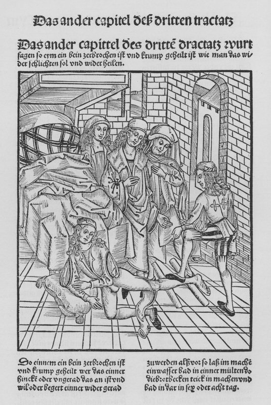 Kirurgian kirja, Hieronymus Brunschwig (litho) tekijältä (after) German School
