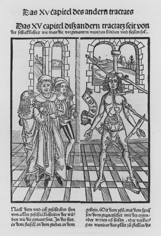Kirurgian kirja, Hieronymus Brunschwig (litho) tekijältä (after) German School