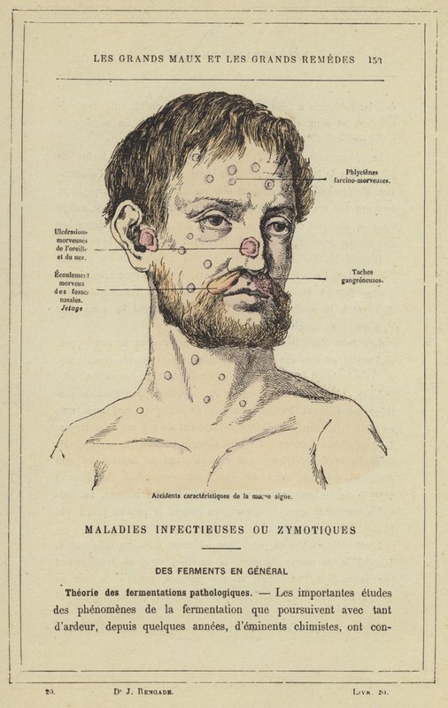 Akuutin räkän tunnusomaiset vedot (väri litho) tekijältä French School