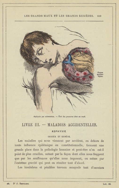 Asfyksia upottamalla, keuhkojen tila hukkumistilassa (väri litho) tekijältä French School